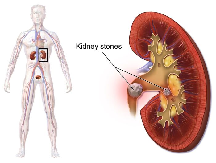 Can diet soda cause kidney stones