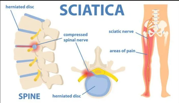 exercises for sciatica