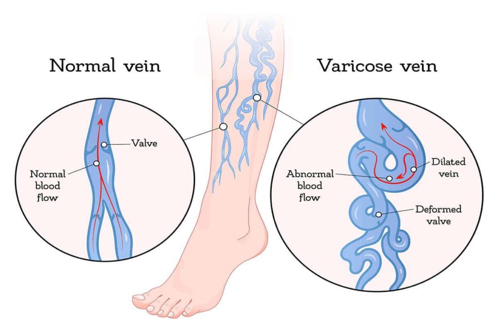 Can varicose veins go away with weight loss?