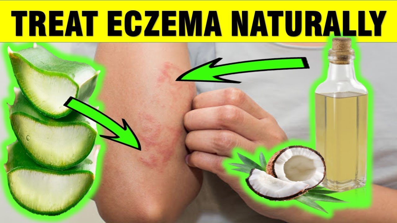 How to Treat Eczema Naturally