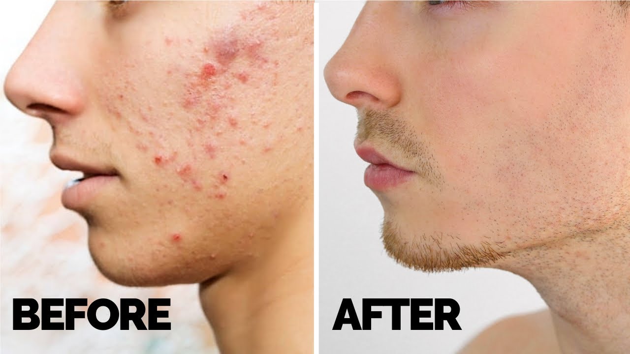 How to get rid of acne scars?