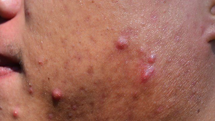 Here are some of the most common treatments for acne scars: