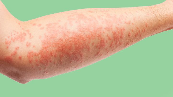 How to Treat Eczema Naturally