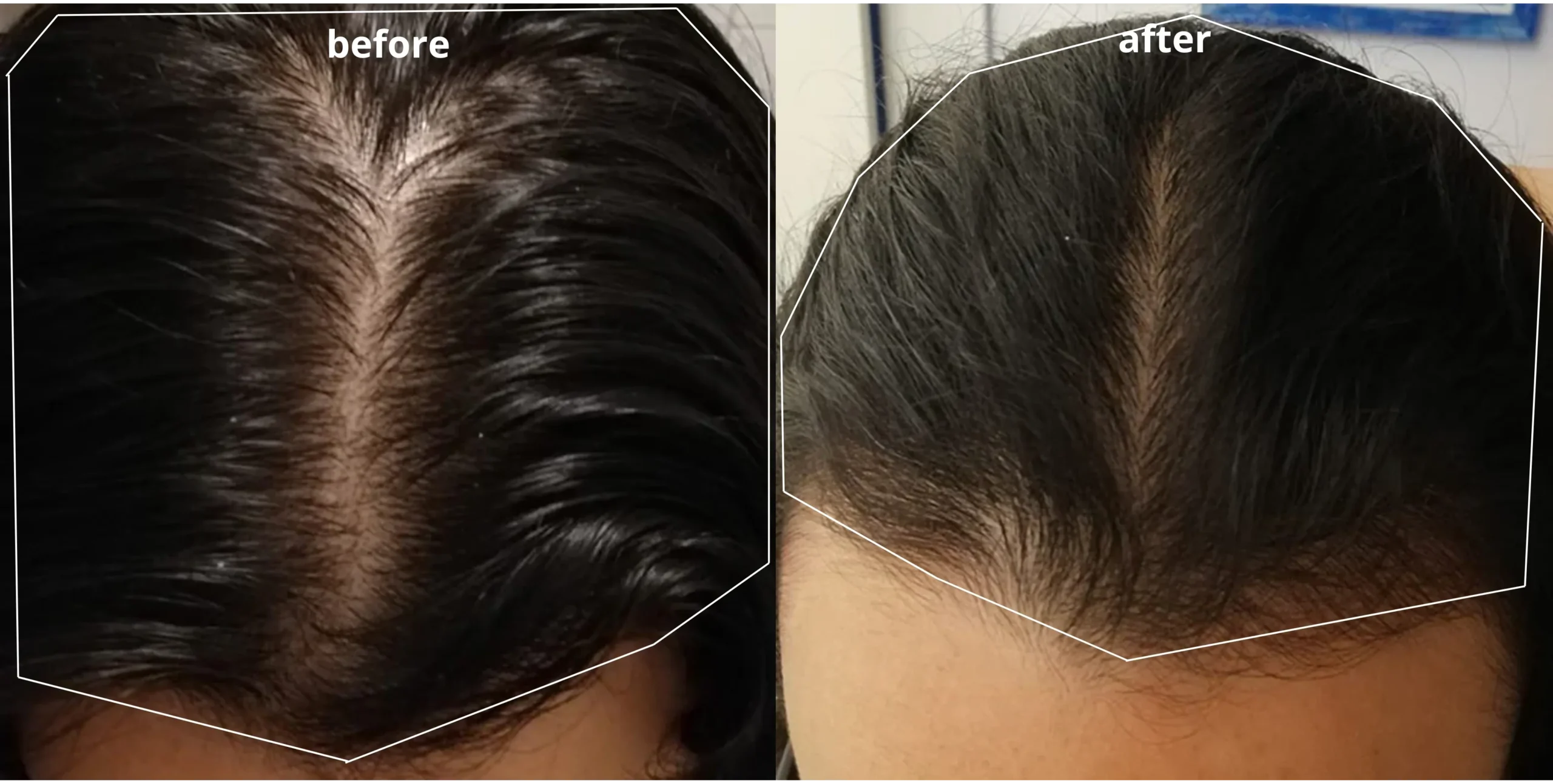 Can Hair Loss Due to Stress Be Reversed?